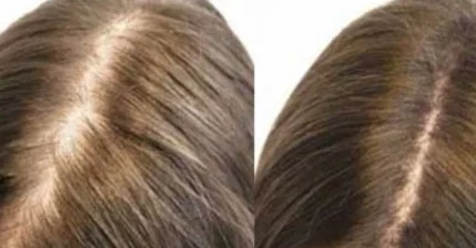 Лечение алопеции и восстановление роста волос